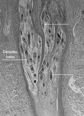 Figure 2A. Demodex mites in a hair follicle.